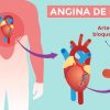 explicación de la angina de pecho