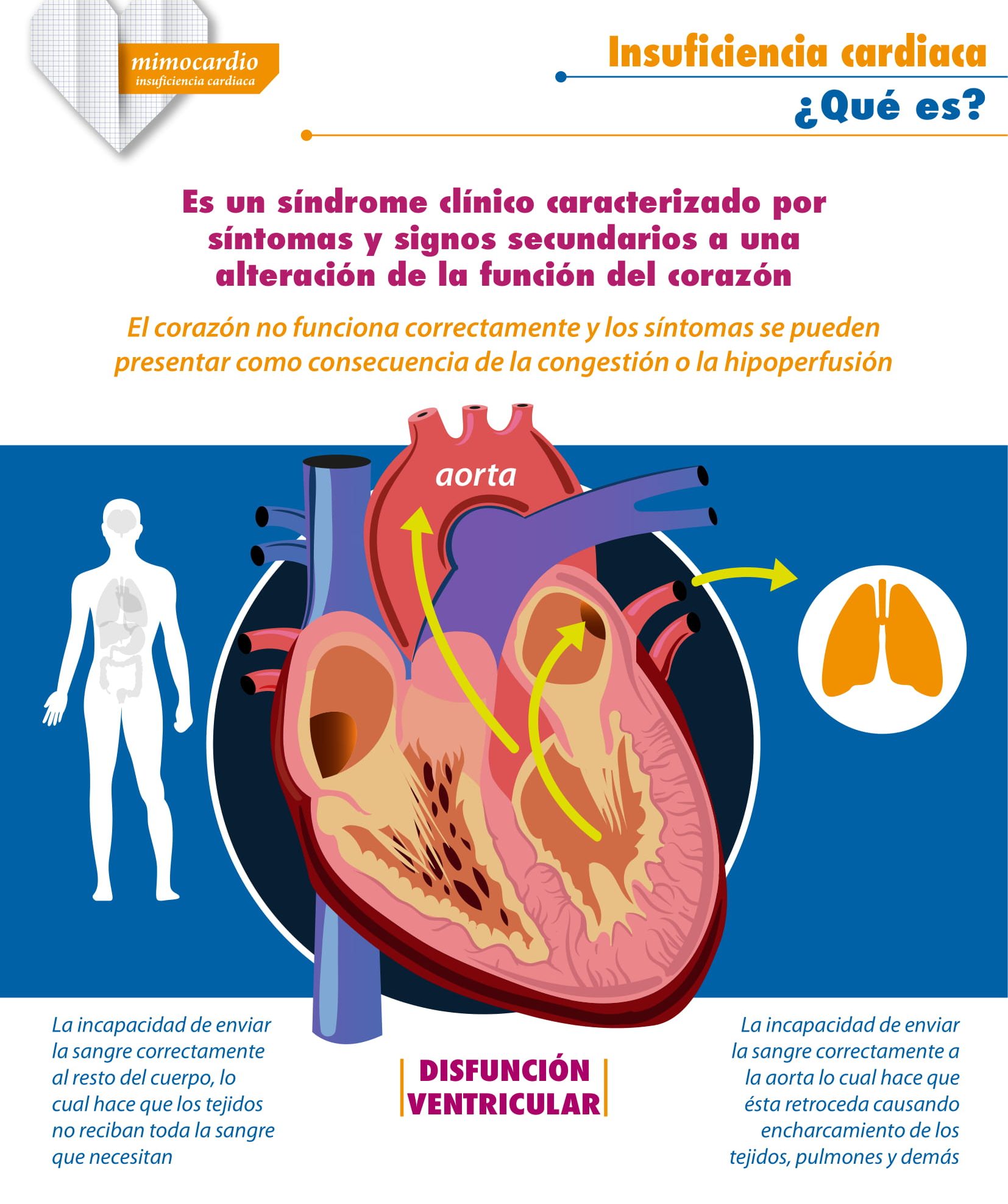 infografía sobre insuficiencia cardiaca 