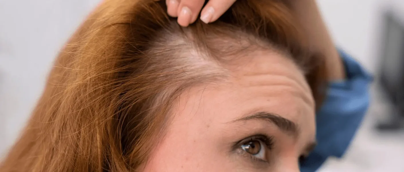 mujer con caída de cabello